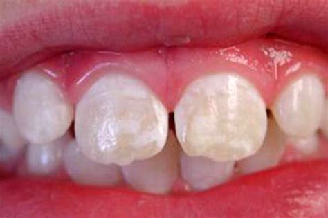 bebeklerde dişlerde beyaz lekeler neden olur